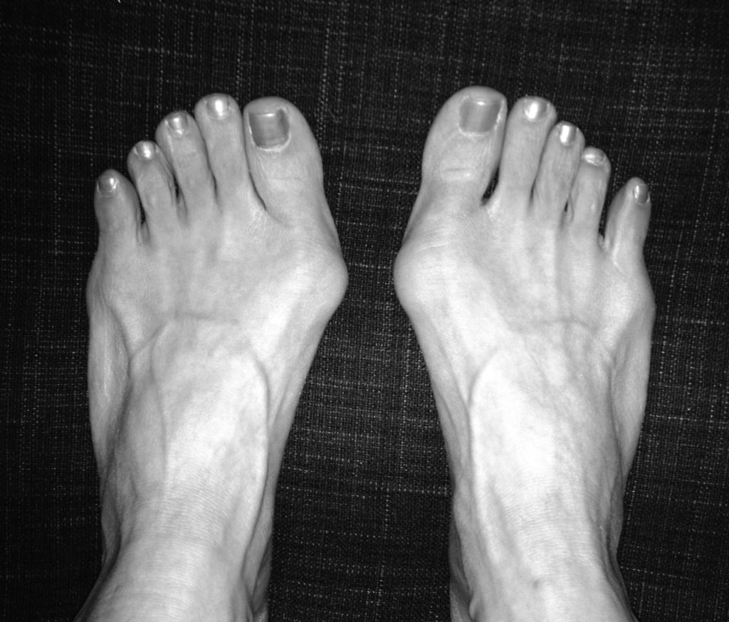 My perfectly imperfect feet - bunions and all! - http://heidipowell.net/227