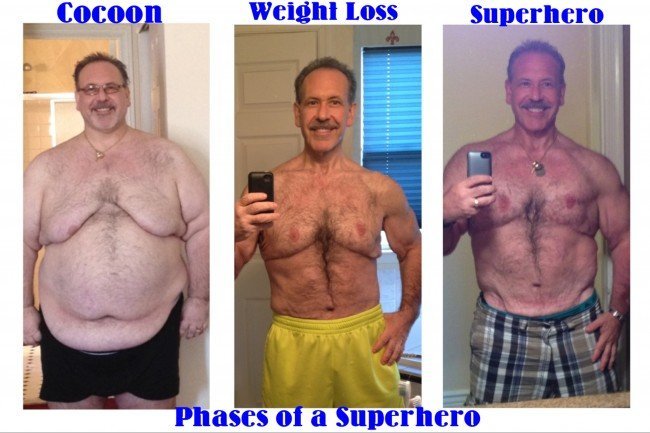 Mike's Story, Weight Loss Patient Stories