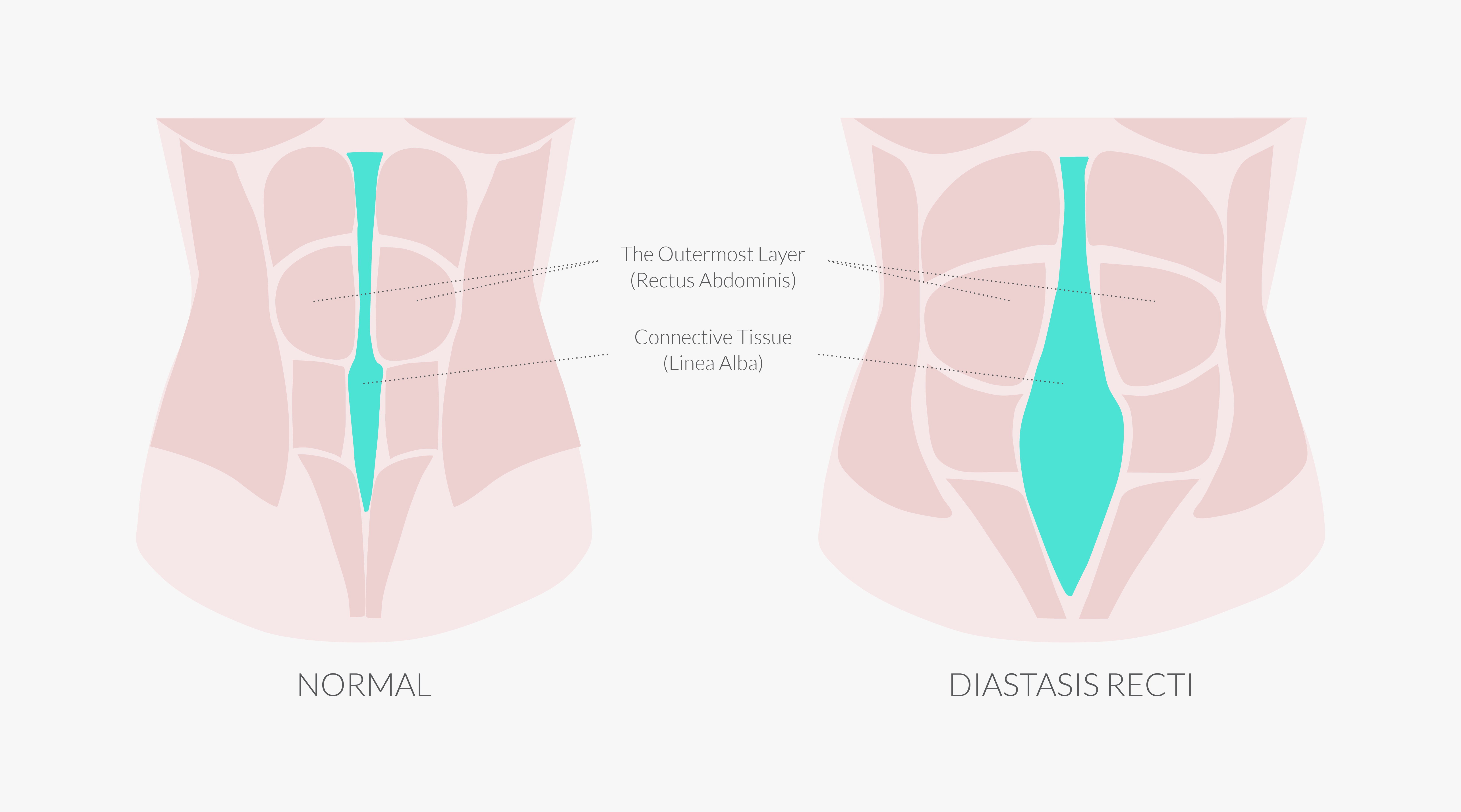 Diastasis Recti: Is It Normal To Have Postpartum Belly Pouch? - Motherhood  Hospitals India